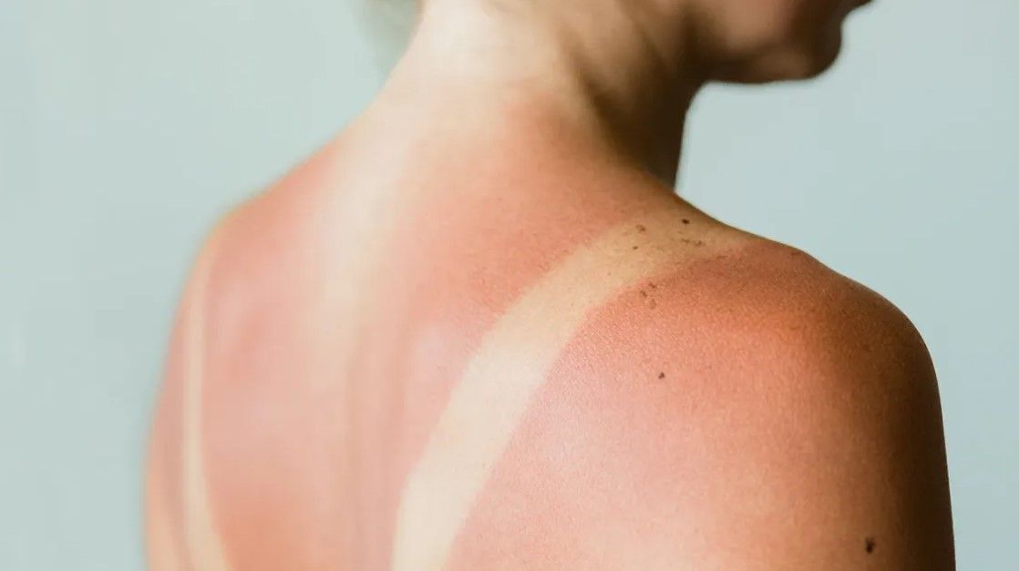 Cara Mencerahkan Kulit Belang